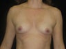 Fat Transfer