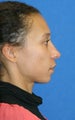 Full Face Fat Transfer