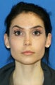 Full Face Fat Transfer