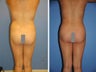 Fat Transfer 