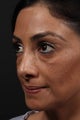 Facial fat grafting