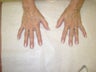 Fat transfer to the hands