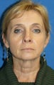 Facelift, Fat Transfer, Lateral Browlift, Lower Eyelid Skin Pinch