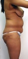 Liposuction with fat grafting / transfer to buttocks