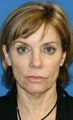 Facelift with Extended Necklift, Lateral Browlift, Fat Transfer, and Skin Pinch