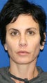 Peri-orbital Fat Transfer, Upper Blepharoplasty, & Skin Pinch