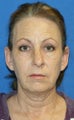 Facelift with Extended Necklift, Fat Transfer, Upper Blepharoplasty and Skin Pinch