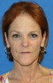 Facelift with Extended Necklift, Fat Transfer, and Skin Pinch