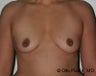 Fat Grafting for Breast Augmentation 
