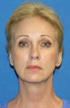 Facelift, Fat Transfer, Upper Bleph, Lower Eyelid Skin Pinch