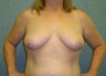 Lipotransfer to the breast