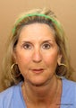 Mid face and face lift  fat transfer to the face