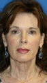 Facelift, Fat Transfer, and Skin Pinch