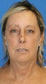 Facelift with Extended Necklift, Fat Transfer, Upper Blepharoplasty & Lower Eyelid Skin Pinch