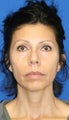 Facelift, Fat Transfer, Upper Bleph, Lower Bleph, & Lower Eyelid Skin Pinch