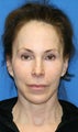 Short Incision Facelift and Fat Transfer