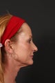 Facial fat grafting