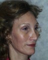 Forehead Lift