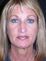 Endoscopic forehead lift