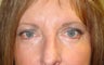 Brow lifting (endoscopic), Quad-blepharoplasty, Chemical peel