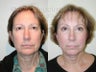 Sluplift, Endoscopic Forehead Lift, Upper and Lower Blepharoplasty 