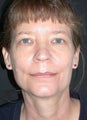 Endoscopic forehead lift, Upper and Lower Blepharoplasty