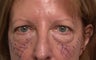 Brow lifting (endoscopic), Quad-blepharoplasty, Chemical peel