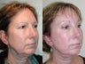 Sluplift, Endoscopic Forehead Lift, Upper and Lower Blepharoplasty 