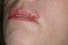 Dog bite repair