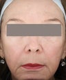 Fractional Resurfacing