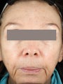 Fractional Resurfacing