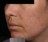 Fraxel - Melasma