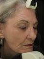 Fraxel Dual Laser 1550 and 1927 Facial Pigmentation and Wrinkles