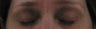 Fraxel for eyelid lift