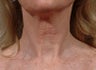 Laser resurfacing-Fraxel Re:store