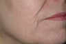 Acne scars treated with Fraxel