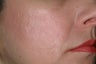 Fraxel Laser
