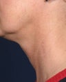 Fraxel - neck