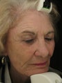 Fraxel Dual Laser 1550 and 1927 Facial Pigmentation and Wrinkles