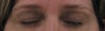 Fraxel for eyelid lift