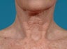 Laser resurfacing-Fraxel Re:store