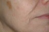 Acne scars treated with Fraxel