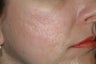 Fraxel Laser