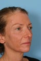 Fraxel Laser treatment