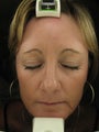 Fraxel re:pair CO2 laser resurfacing 4 month picture