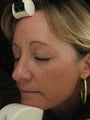 Fraxel re:pair CO laser resurfacing for fine lines and pigmentation