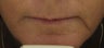 Fraxel re:pair for upper lip lines after 1 treatment