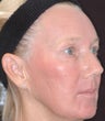 Fraxel re:pair CO laser resurfacing for lips, cheeks, and eye wrinkles