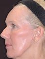 Fraxel re:pair CO2 laser resurfacing for lips, cheeks, marionette lines