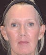 Fraxel re:pair CO2 laser resurfacing for lip lines, marionette lines, cheek wrinkles and eyes